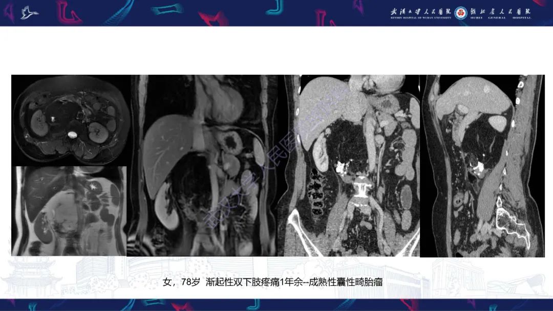 【PPT】盆腹腔巨大占位性病变影像诊断-47