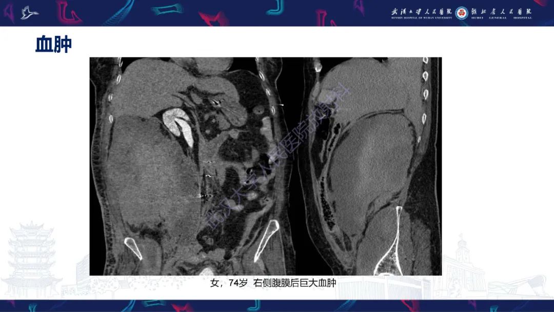 【PPT】盆腹腔巨大占位性病变影像诊断-7