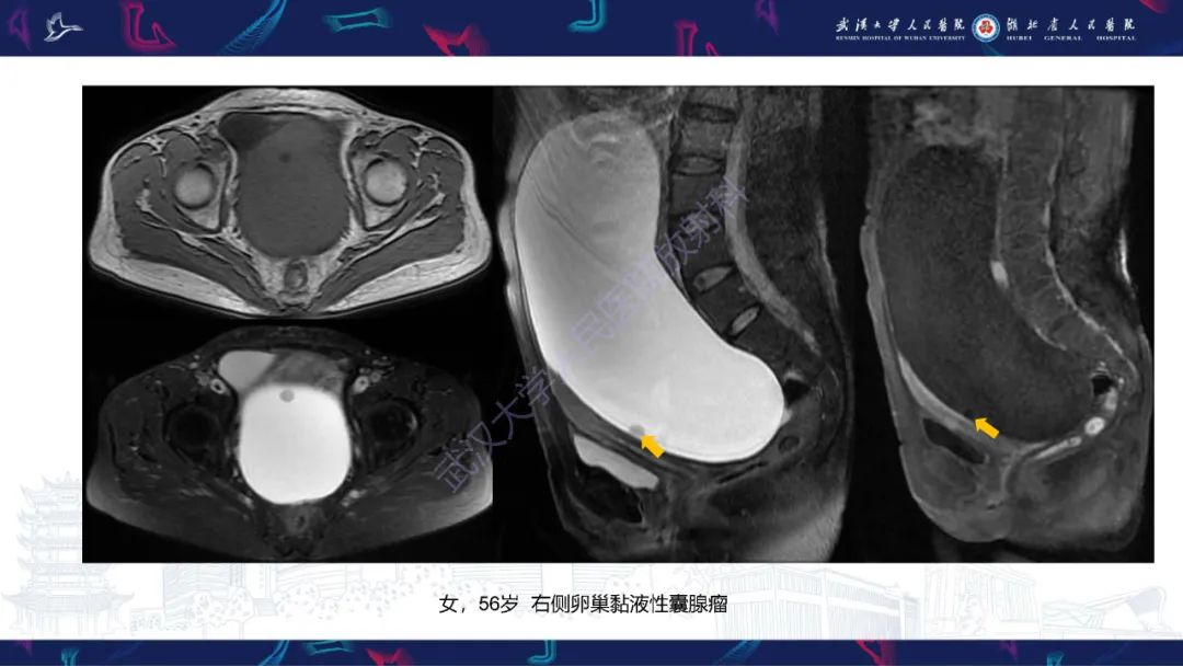 【PPT】盆腹腔巨大占位性病变影像诊断-21