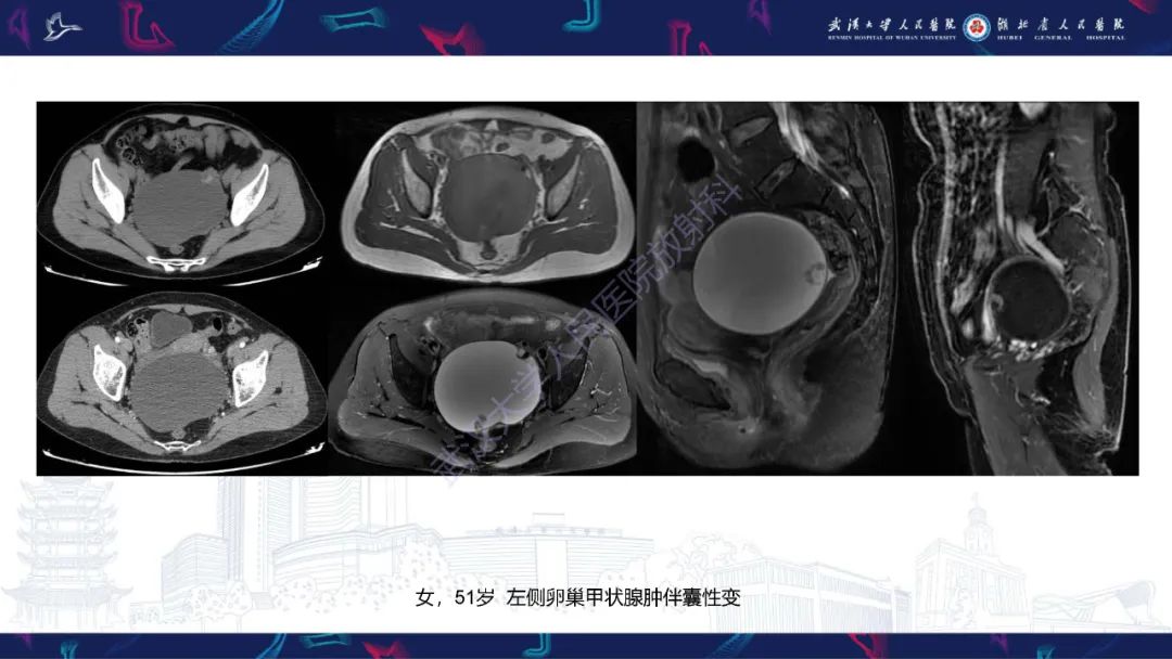 【PPT】盆腹腔巨大占位性病变影像诊断-37