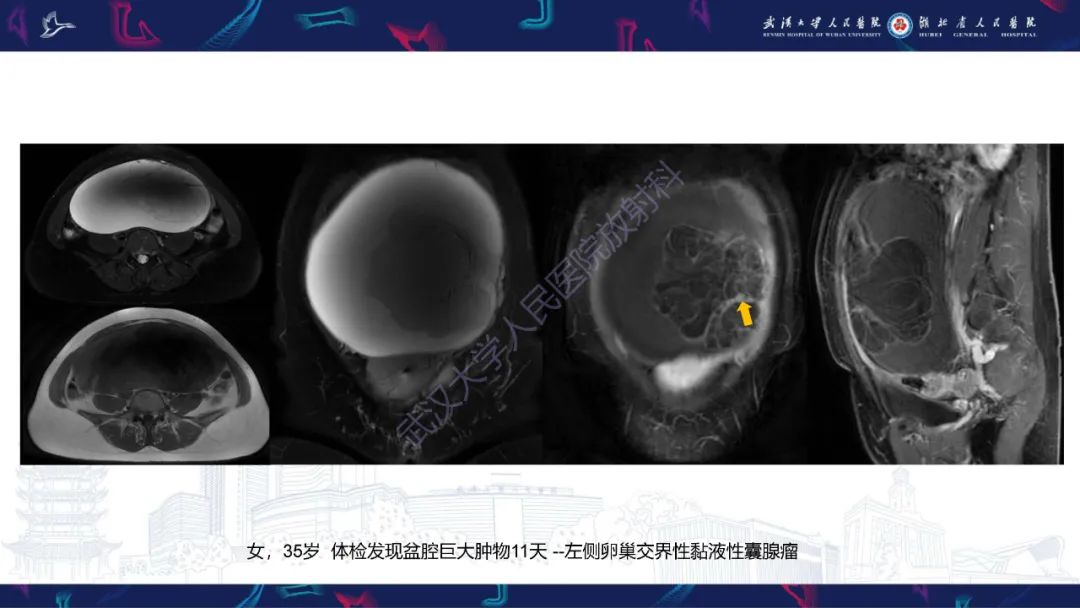 【PPT】盆腹腔巨大占位性病变影像诊断-23