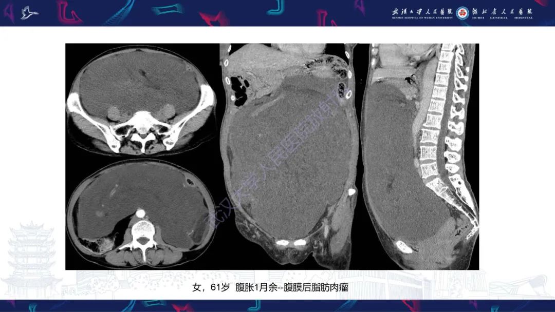 【PPT】盆腹腔巨大占位性病变影像诊断-44