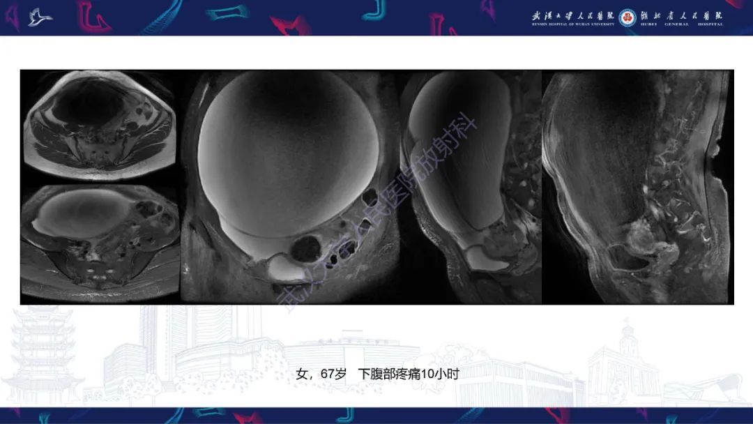 【PPT】盆腹腔巨大占位性病变影像诊断-3