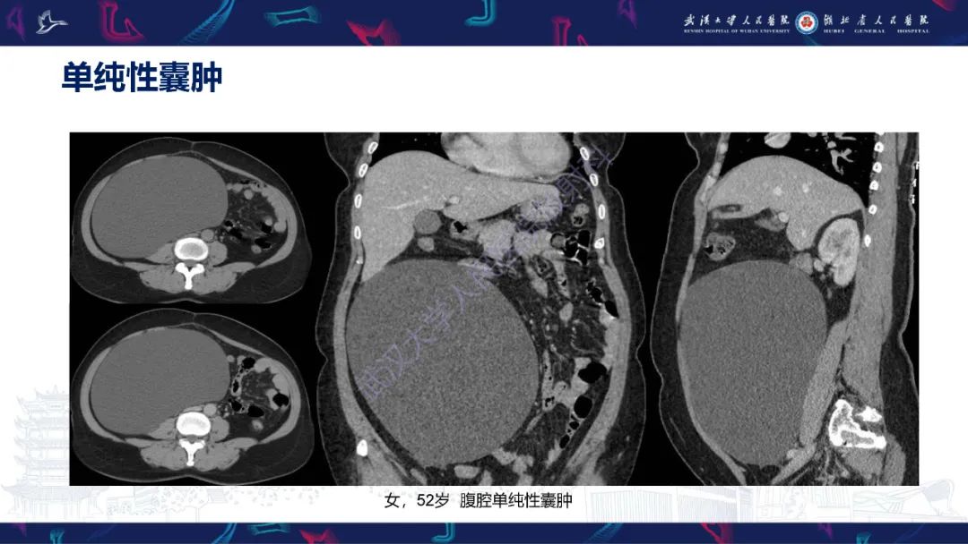 【PPT】盆腹腔巨大占位性病变影像诊断-8