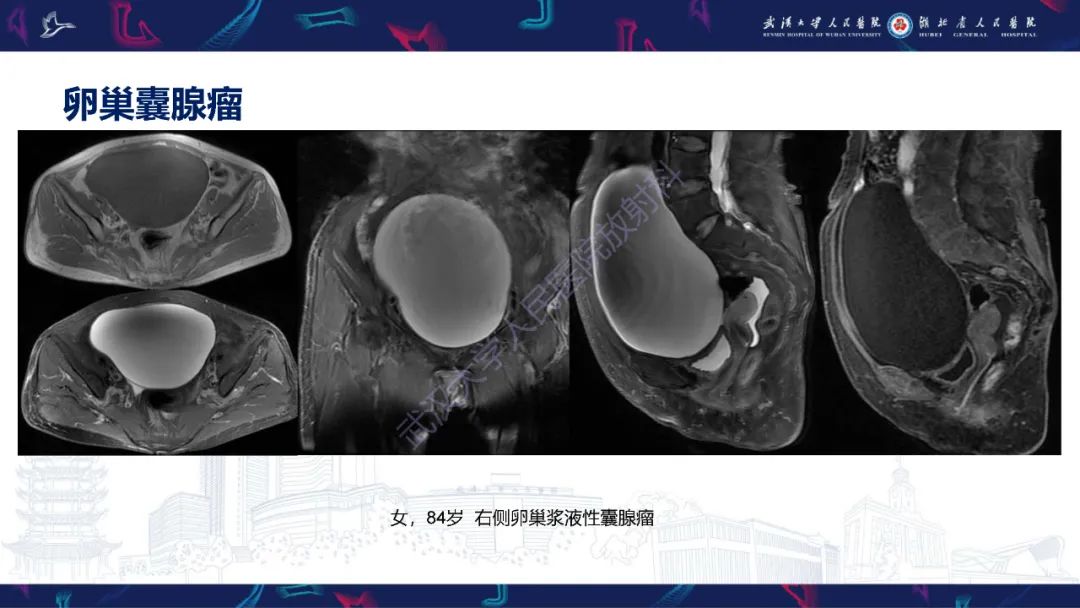 【PPT】盆腹腔巨大占位性病变影像诊断-15