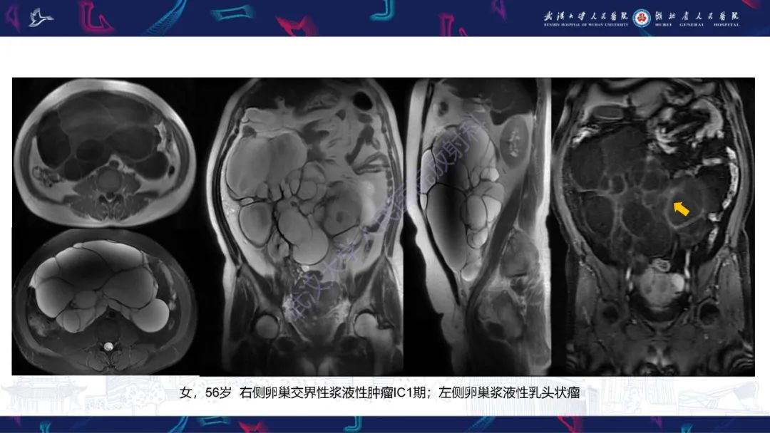 【PPT】盆腹腔巨大占位性病变影像诊断-33