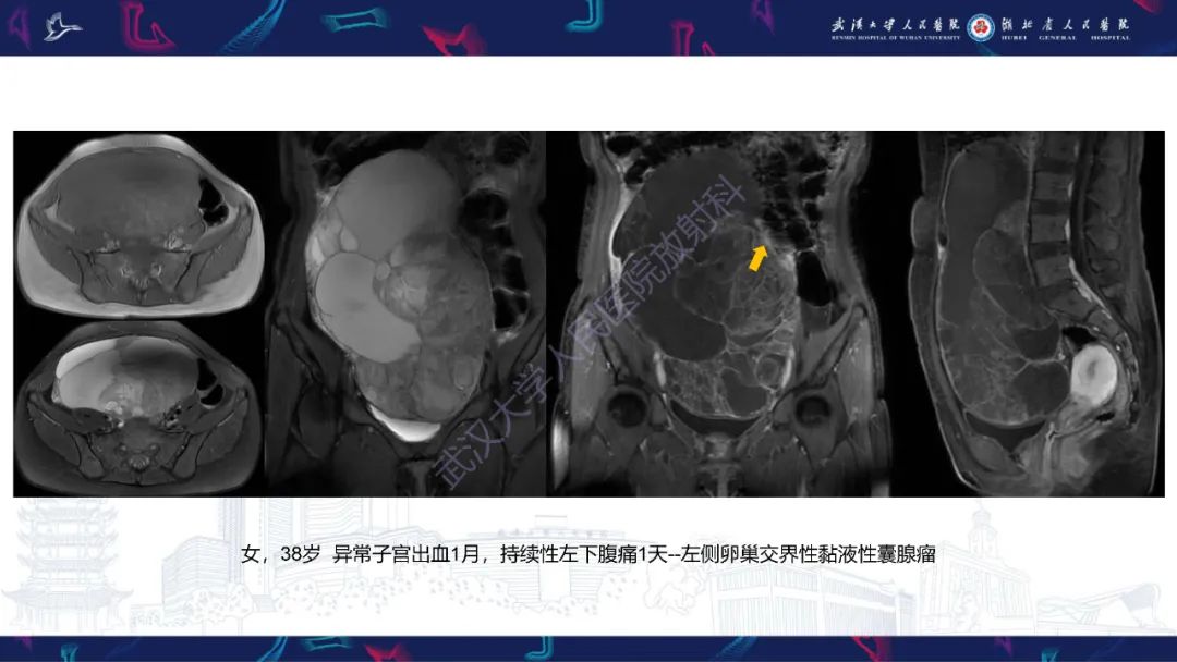 【PPT】盆腹腔巨大占位性病变影像诊断-29