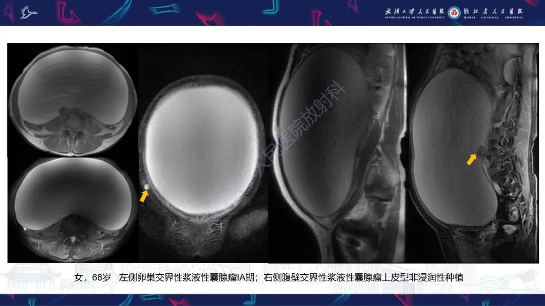 【PPT】盆腹腔巨大占位性病变影像诊断-34