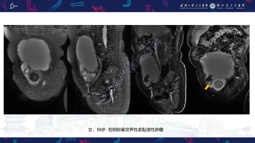 【PPT】盆腹腔巨大占位性病变影像诊断-26