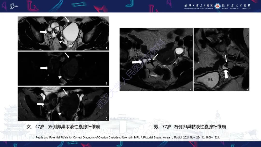 【PPT】盆腹腔巨大占位性病变影像诊断-40