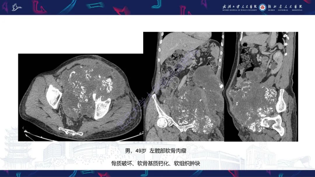 【PPT】盆腹腔巨大占位性病变影像诊断-49