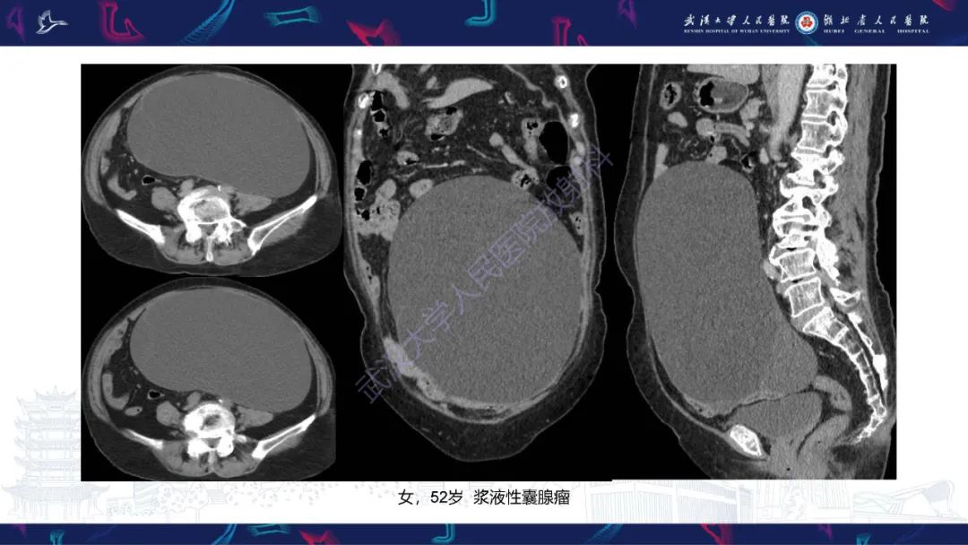 【PPT】盆腹腔巨大占位性病变影像诊断-16
