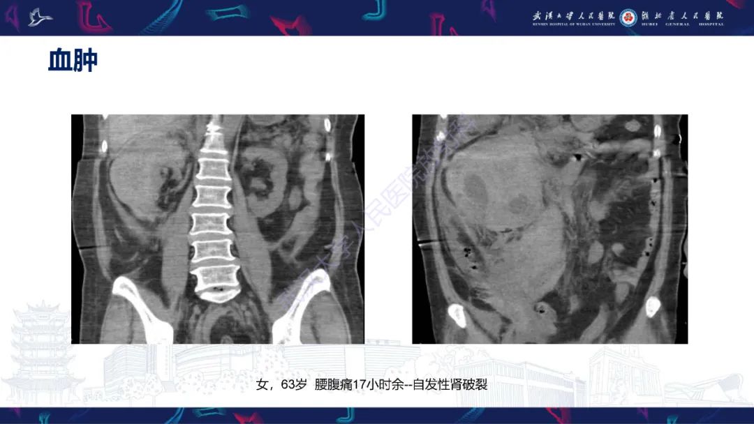 【PPT】盆腹腔巨大占位性病变影像诊断-9