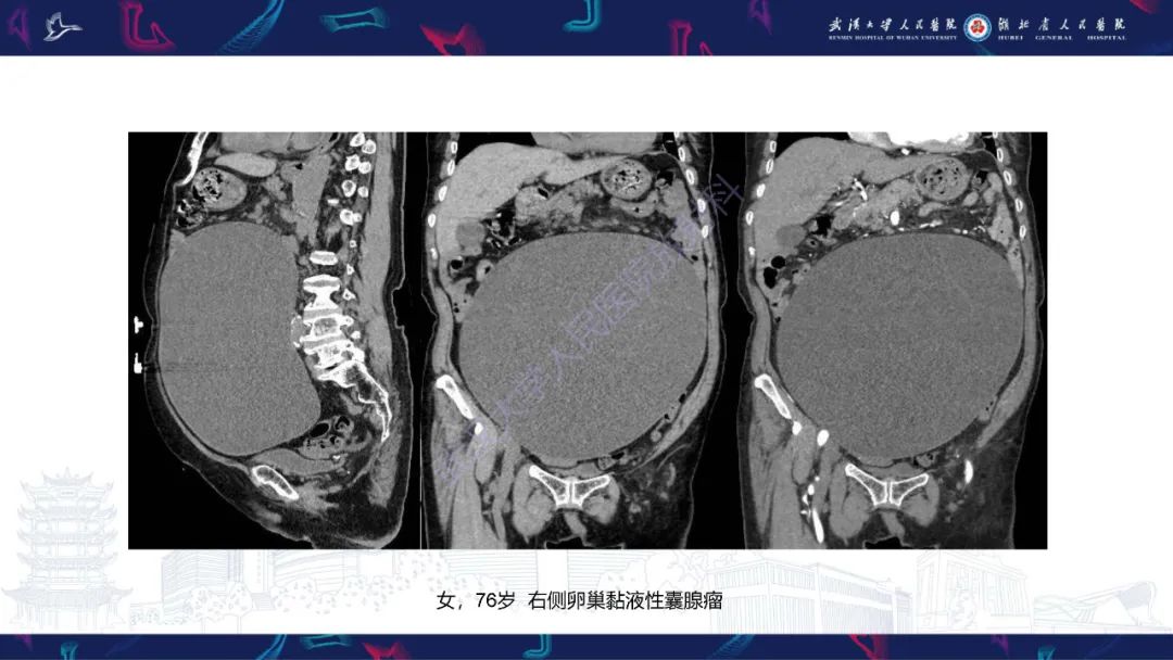 【PPT】盆腹腔巨大占位性病变影像诊断-17