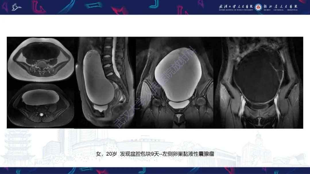 【PPT】盆腹腔巨大占位性病变影像诊断-19