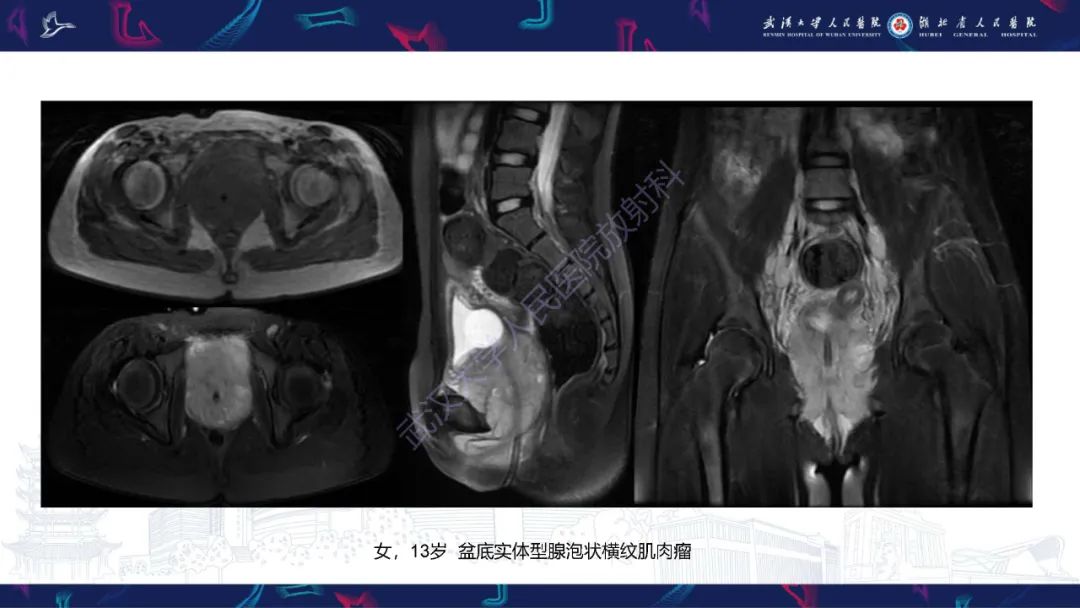 【PPT】盆腹腔巨大占位性病变影像诊断-82