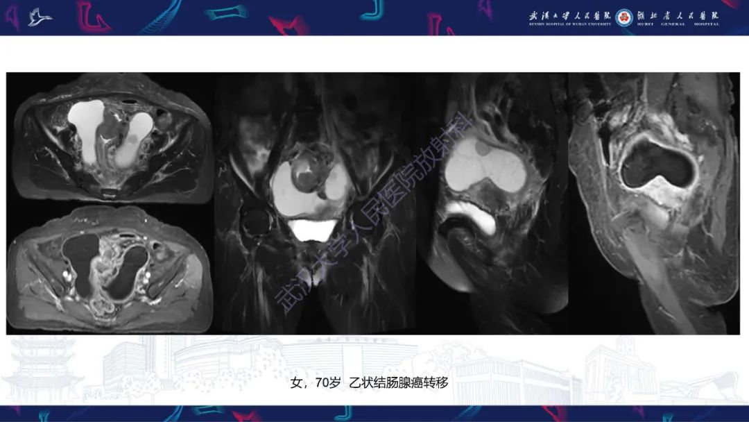 【PPT】盆腹腔巨大占位性病变影像诊断-70