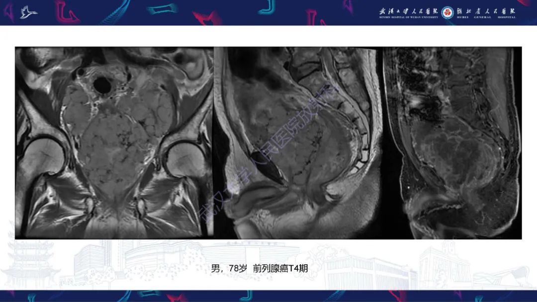 【PPT】盆腹腔巨大占位性病变影像诊断-79