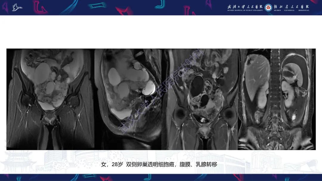 【PPT】盆腹腔巨大占位性病变影像诊断-63