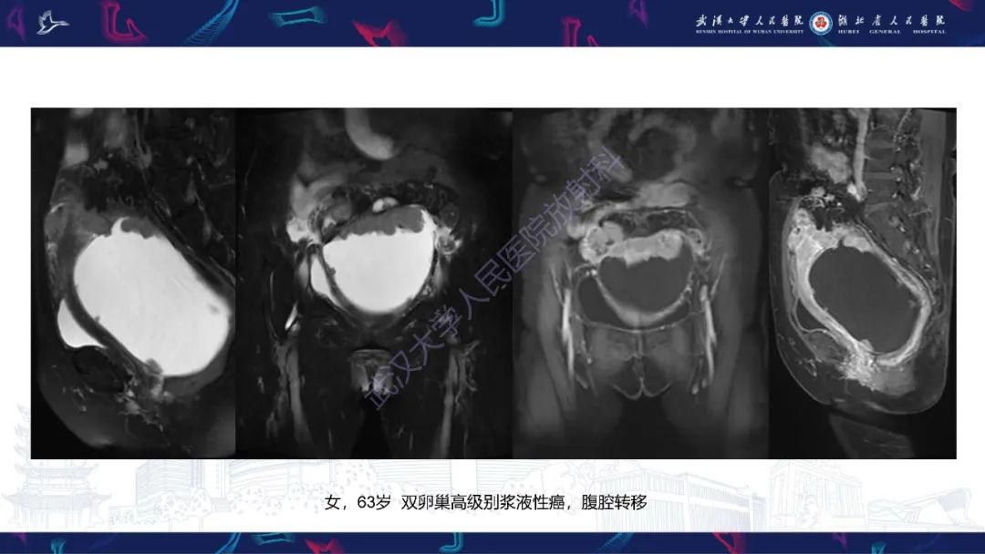 【PPT】盆腹腔巨大占位性病变影像诊断-62