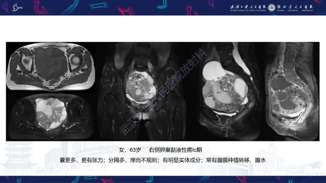 【PPT】盆腹腔巨大占位性病变影像诊断-73
