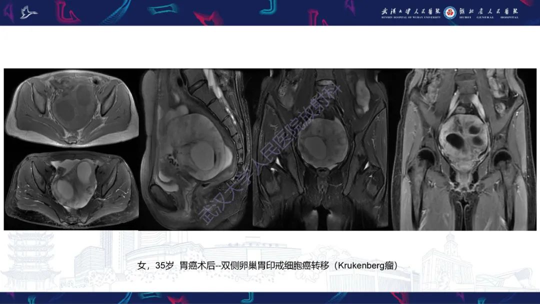 【PPT】盆腹腔巨大占位性病变影像诊断-64