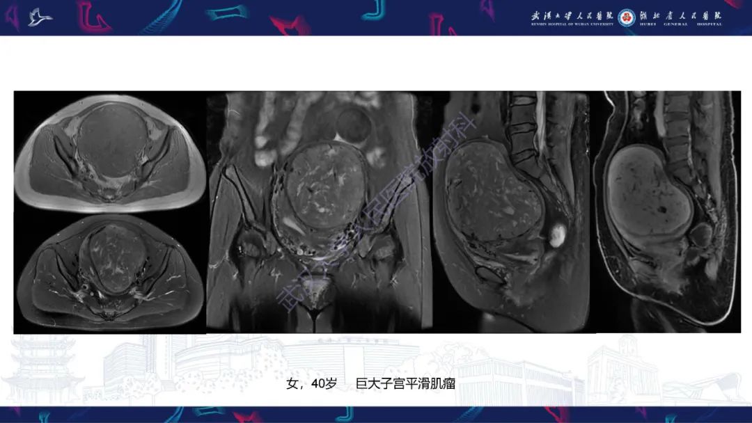 【PPT】盆腹腔巨大占位性病变影像诊断-53