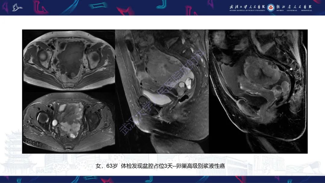 【PPT】盆腹腔巨大占位性病变影像诊断-75