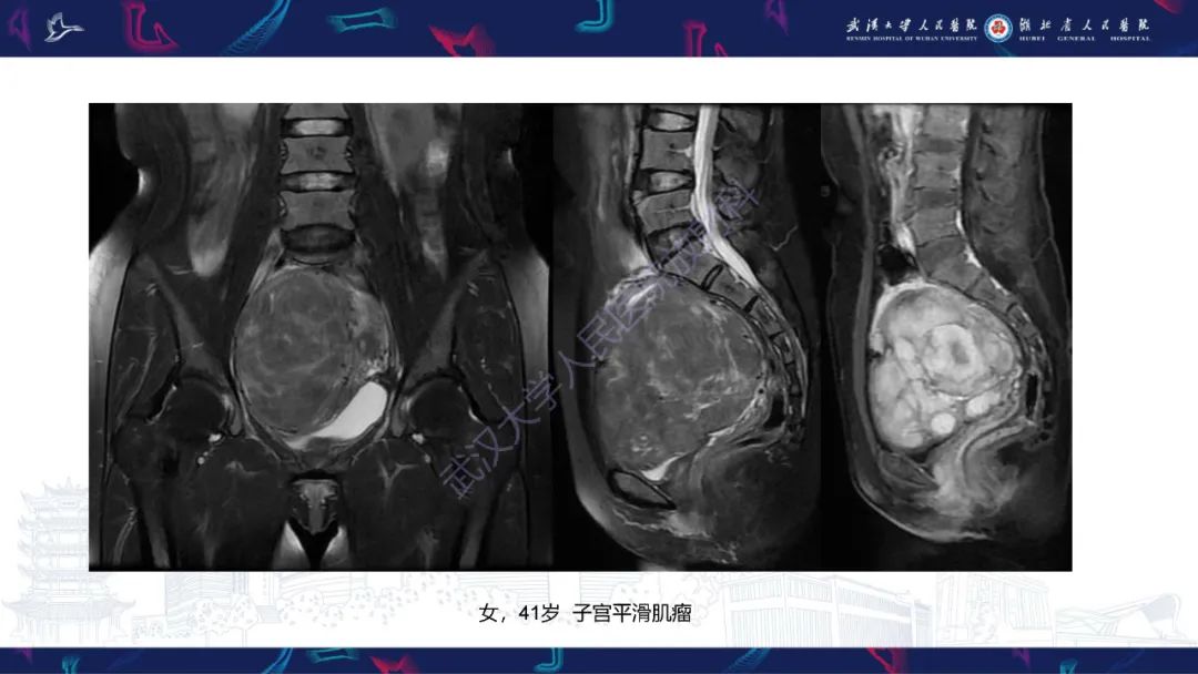 【PPT】盆腹腔巨大占位性病变影像诊断-54