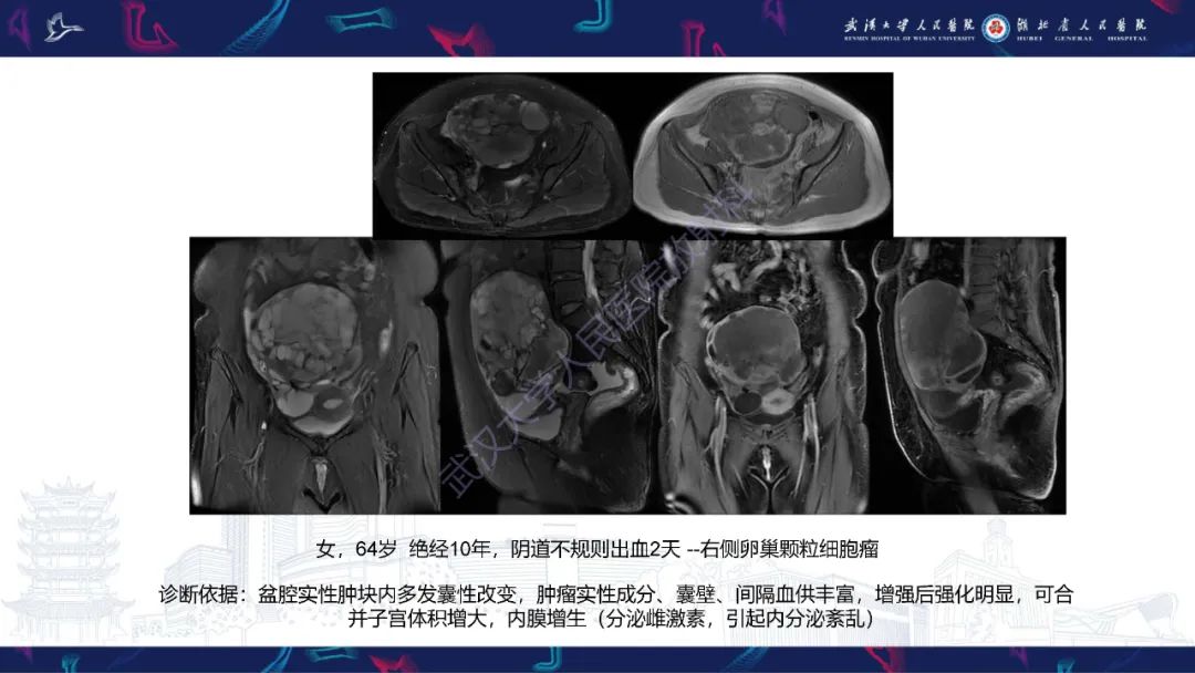【PPT】盆腹腔巨大占位性病变影像诊断-58