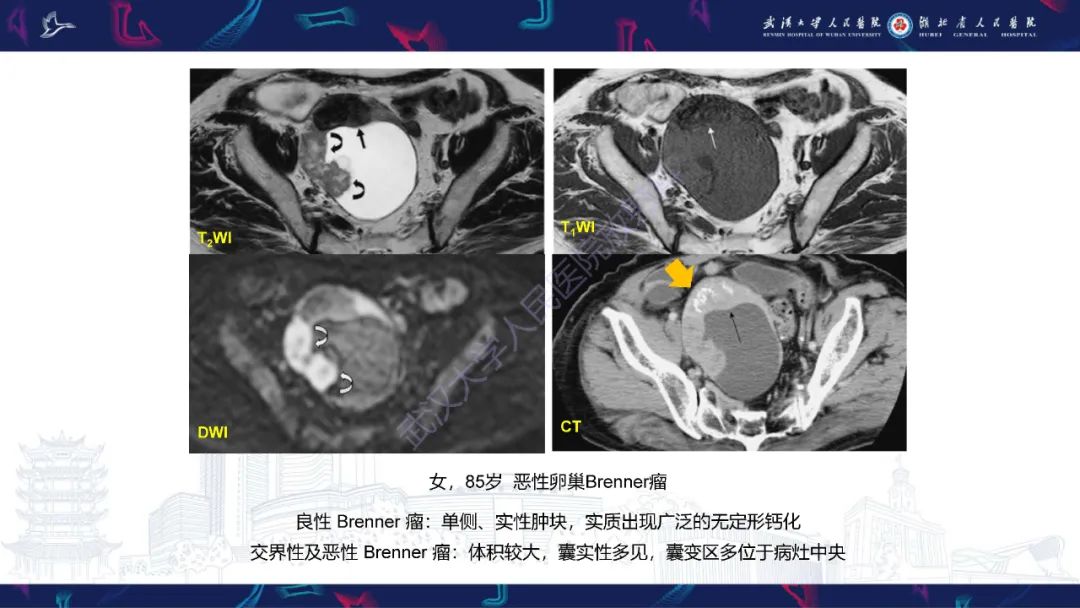 【PPT】盆腹腔巨大占位性病变影像诊断-57