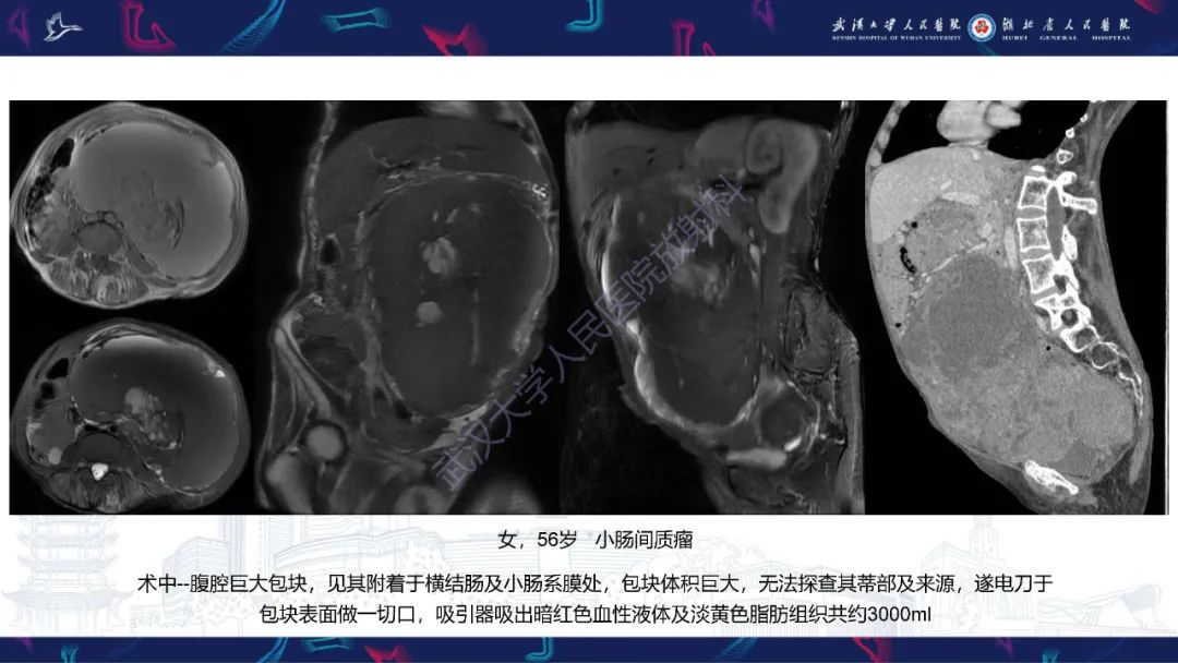 【PPT】盆腹腔巨大占位性病变影像诊断-72