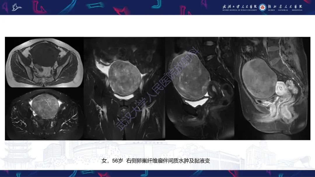 【PPT】盆腹腔巨大占位性病变影像诊断-56