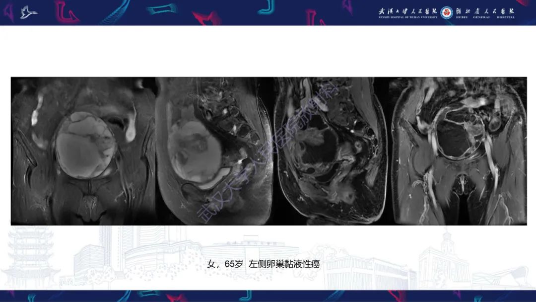 【PPT】盆腹腔巨大占位性病变影像诊断-77