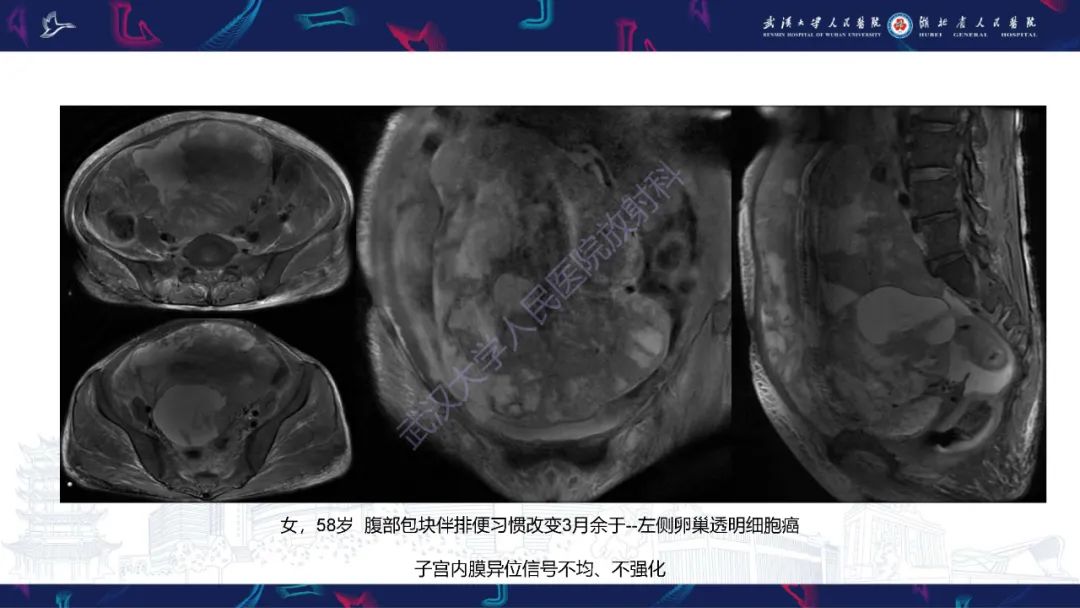 【PPT】盆腹腔巨大占位性病变影像诊断-59