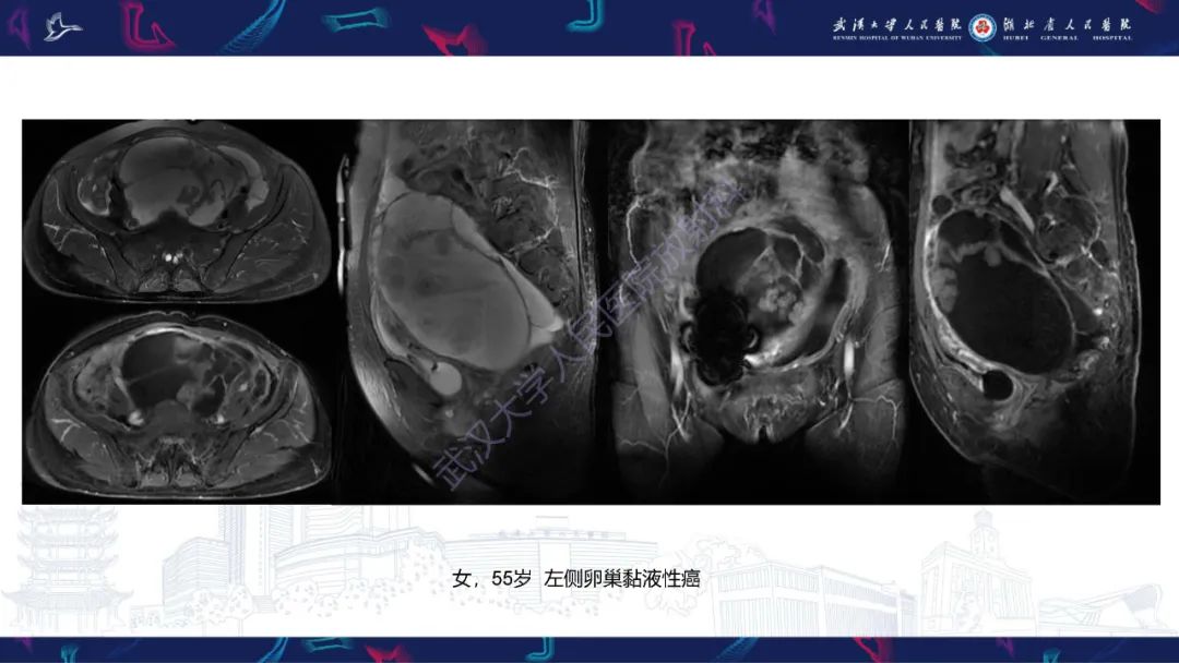 【PPT】盆腹腔巨大占位性病变影像诊断-76