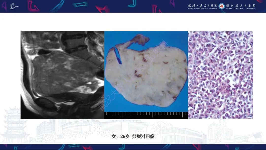 【PPT】盆腹腔巨大占位性病变影像诊断-60