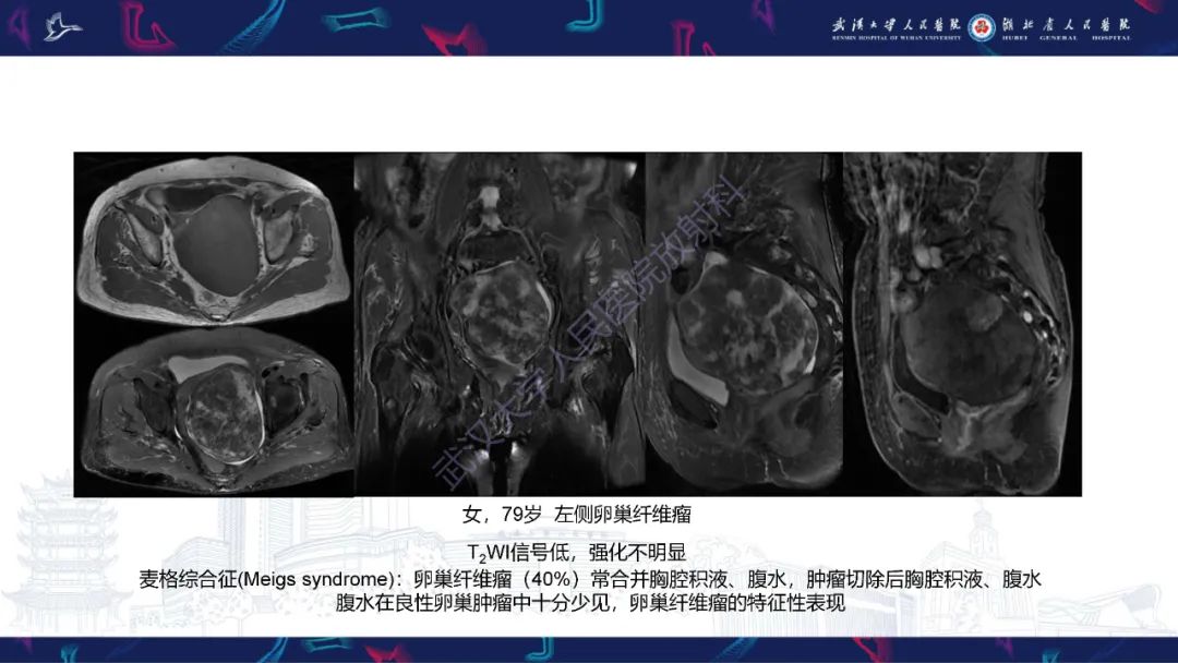 【PPT】盆腹腔巨大占位性病变影像诊断-55