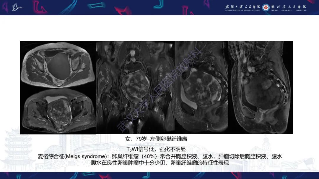 【PPT】盆腹腔巨大占位性病变影像诊断-55
