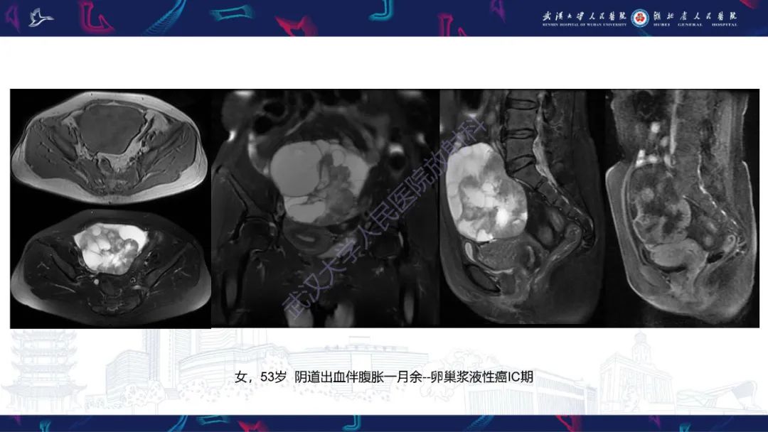 【PPT】盆腹腔巨大占位性病变影像诊断-74