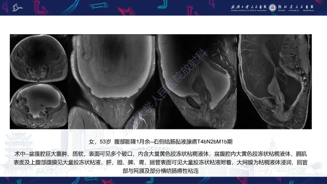 【PPT】盆腹腔巨大占位性病变影像诊断-69