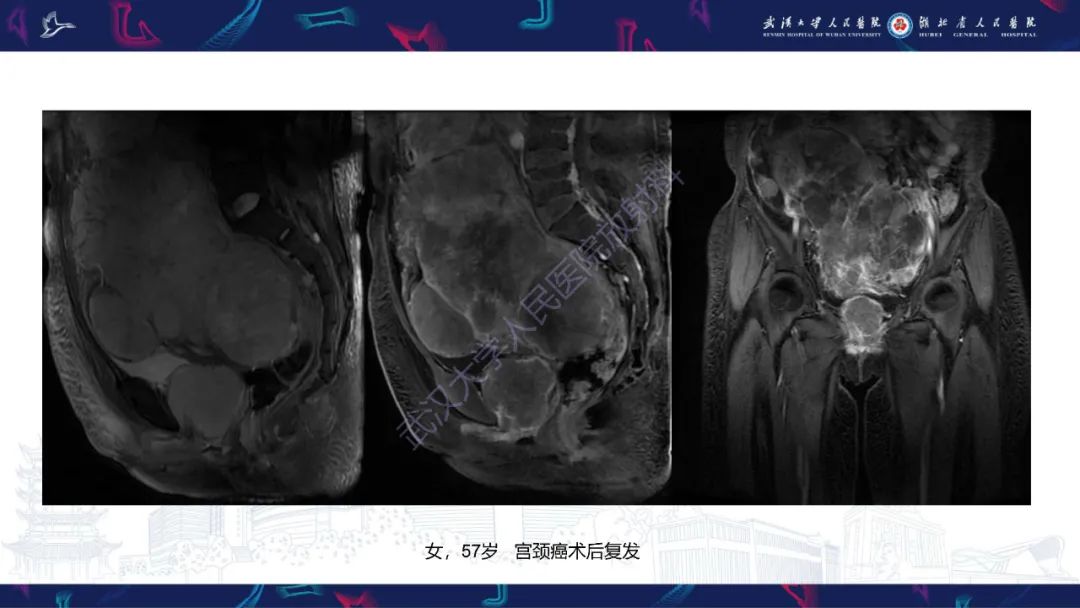 【PPT】盆腹腔巨大占位性病变影像诊断-80