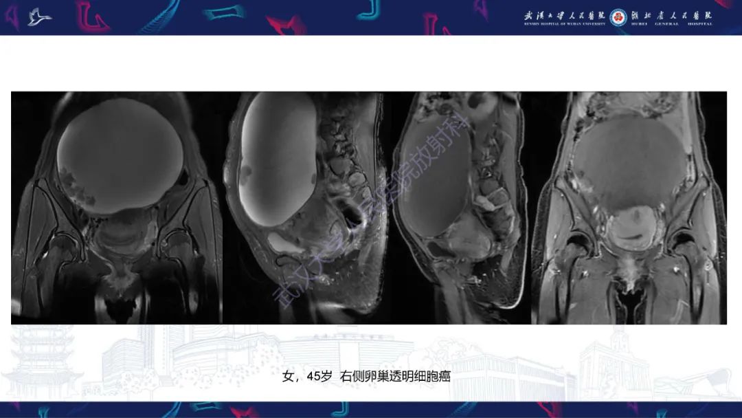 【PPT】盆腹腔巨大占位性病变影像诊断-66