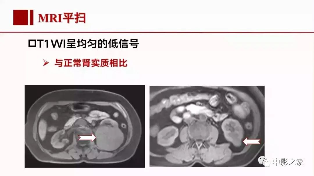【PPT】肾嫌色细胞癌影像诊断、鉴别、分级与预后评估-21