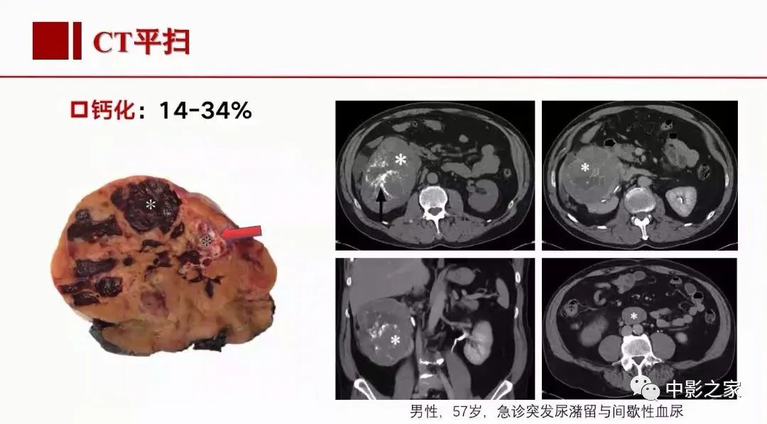 【PPT】肾嫌色细胞癌影像诊断、鉴别、分级与预后评估-19