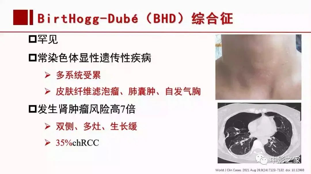 【PPT】肾嫌色细胞癌影像诊断、鉴别、分级与预后评估-7