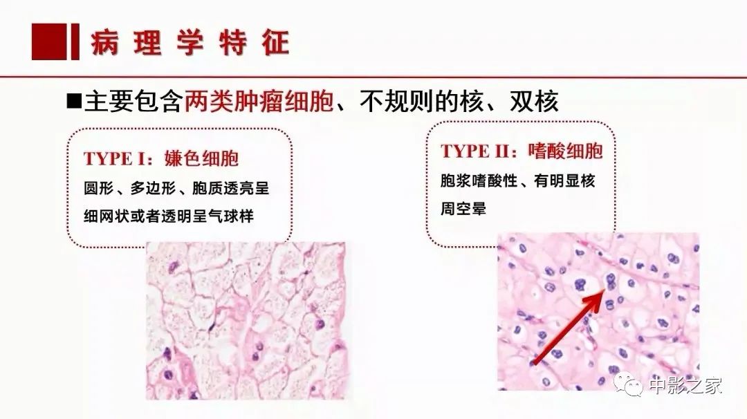 【PPT】肾嫌色细胞癌影像诊断、鉴别、分级与预后评估-14