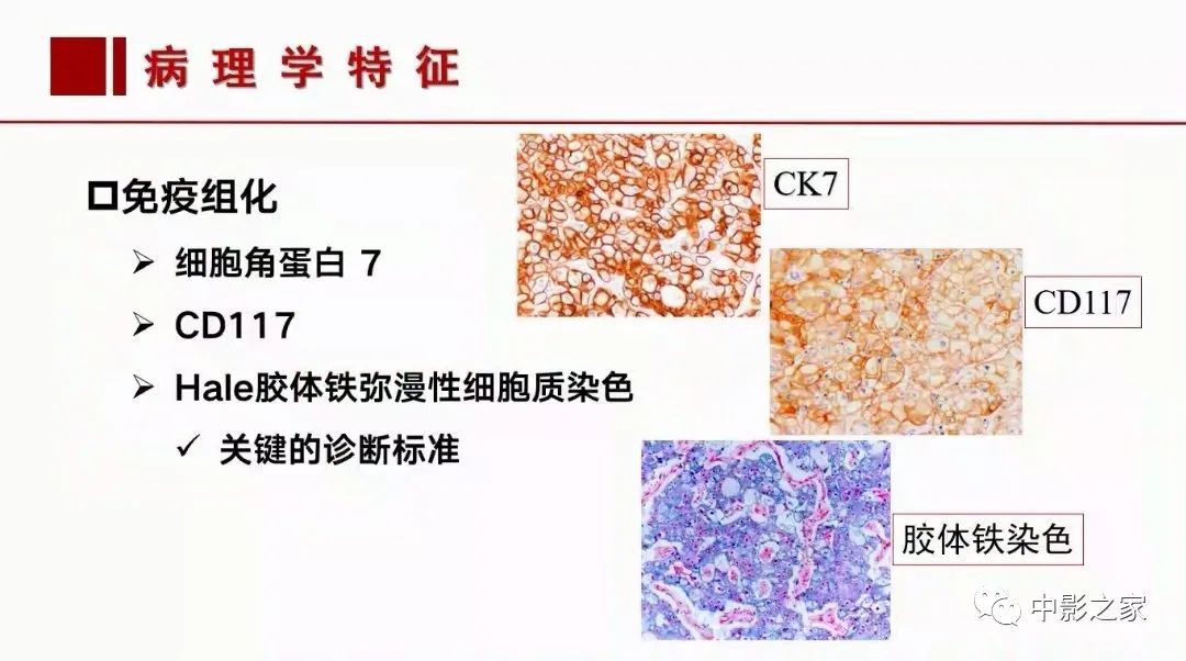 【PPT】肾嫌色细胞癌影像诊断、鉴别、分级与预后评估-15