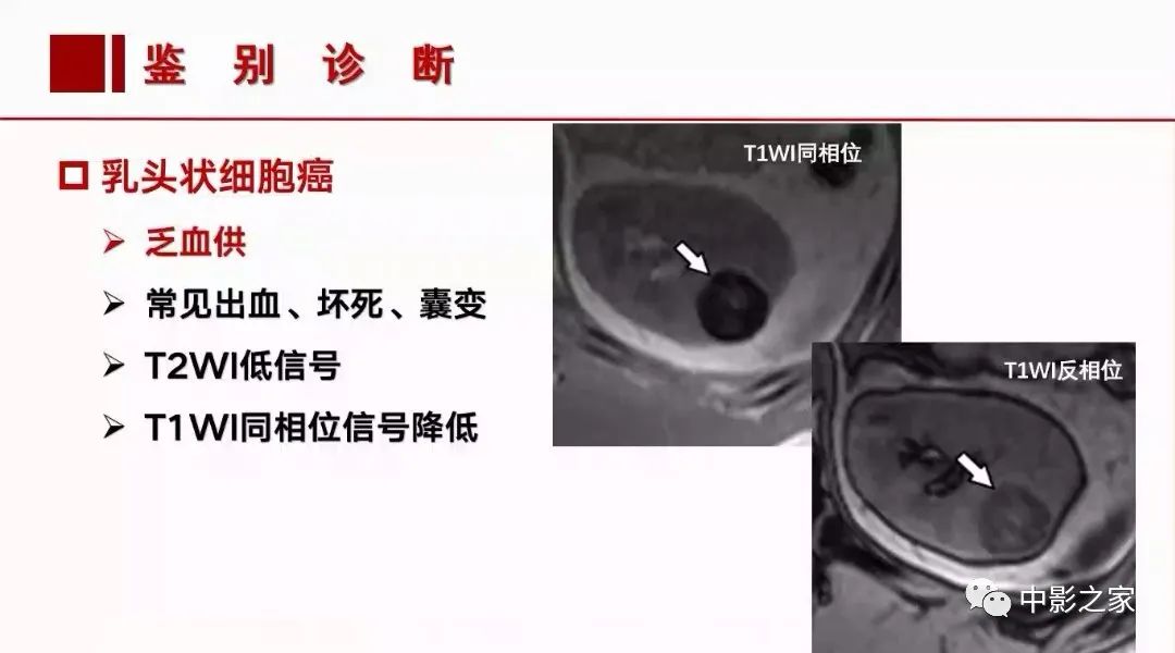 【PPT】肾嫌色细胞癌影像诊断、鉴别、分级与预后评估-34