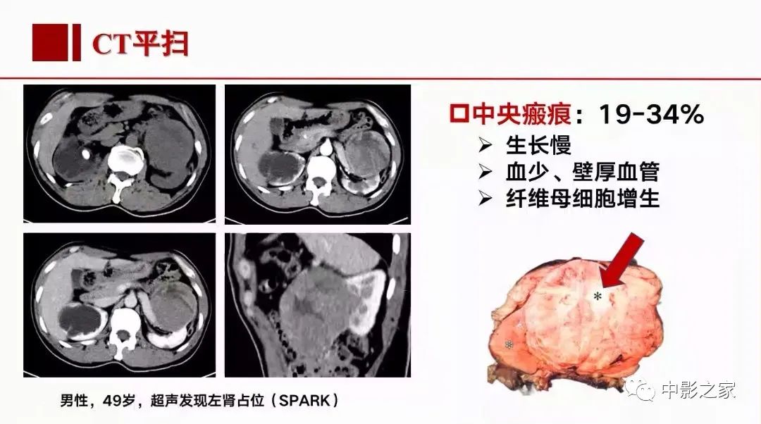 【PPT】肾嫌色细胞癌影像诊断、鉴别、分级与预后评估-20